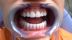 Безметалловая керамика - будущее протезирования зубов