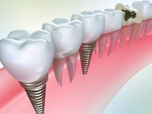 Имплантация зубов при пародонтите