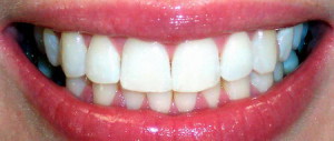 Протезирование зубов с помощью металлокерамики