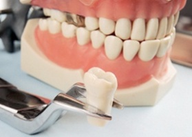 Виды протезирования зубов у людей