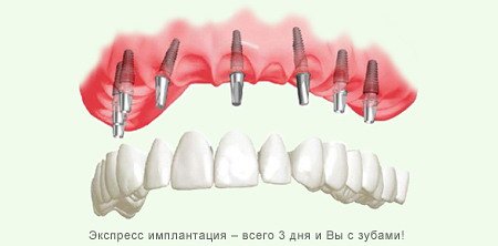 Протезирование зубов. Имплантация