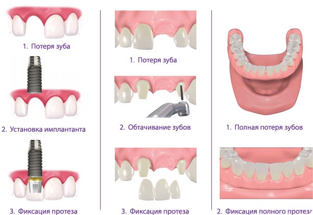 Стоимость, виды, материалы. Протезирование зубов