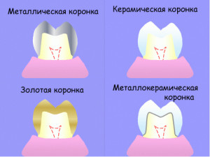 Зубные коронки: какие лучше?