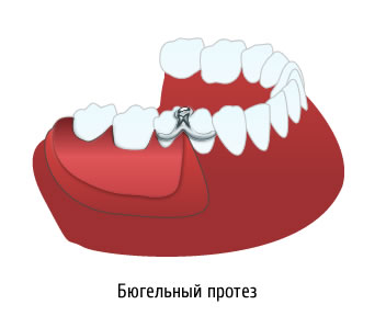 Бюгельные протезы: плюсы и минусы. Стоимость