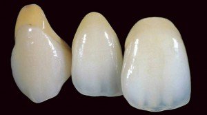 Еще вопросы о керамических зубах