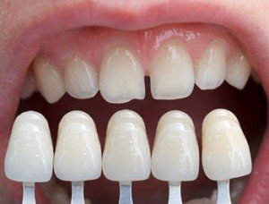 Протезирование зубов без обточки. Преимущества методики