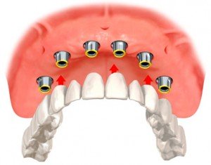 Несъемные зубные протезы в Сумах