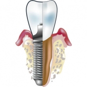 Почему происходит отторжение зубных имплантов?