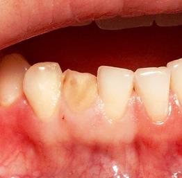 Коррекция десневого контура при протезировании зубов
