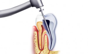 Эндодонтия и лечение каналов зуба