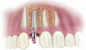 Имплантация зубов без разреза