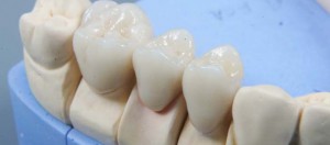 Металлокерамика и протезирование зубов 