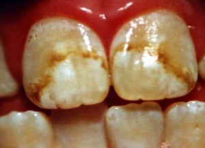Флюороз зубов и его лечение