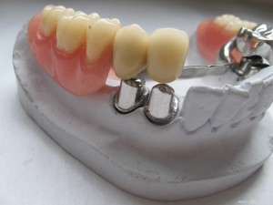 Телескопические протезы зубов