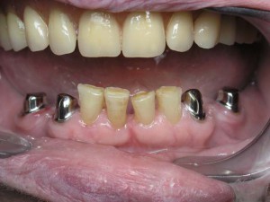 Еще информация о телескопических протезы на зубы