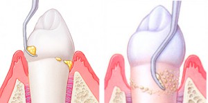Появление и удаление зубного камня