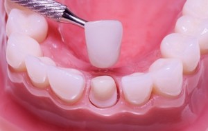 Установка зубных коронок и реабилитация