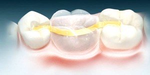 Какие основные этапы микропротезирования зубов?