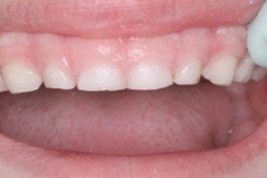 Причины стираемости зубов