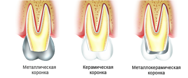 Починка сколов на зубных коронках