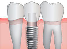 Имплантация в современной стоматологии