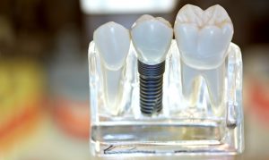 Про современную имплантацию зубов