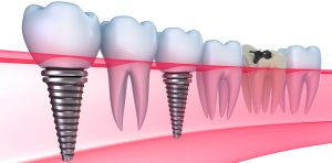 Современная имплантация зубов в стоматологии