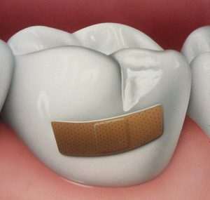 Про лечение кариеса зубов