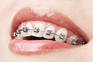 Каким образом работают брекеты на зубы?
