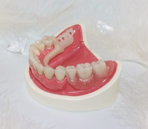 Про фиксированные зубные протезы