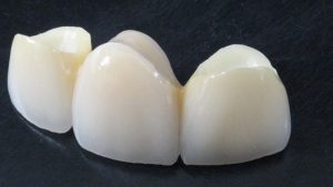 Мостовидные зубные конструкции