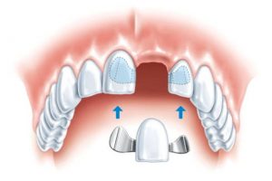 Современное микропротезирование зубов
