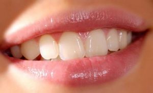 Как можно нарастить зубы? Показания и противопоказания