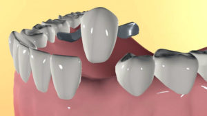 Протезирование зубов без обточки. Какие плюсы?