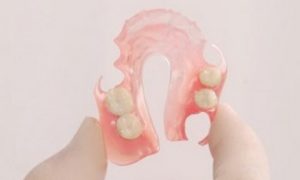 Частичные съемные протезы в стоматологии