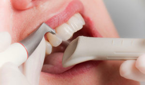 Эффективные методы удаления зубных камней