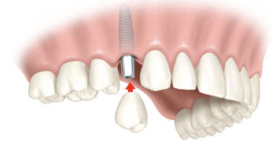 Установка зубных имплантов
