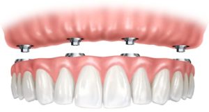 Виды зубных протезов на имплантах
