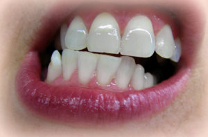 Причины повреждения эмали зубов
