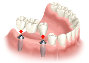 Протезирование зубов на имплантах Сумы