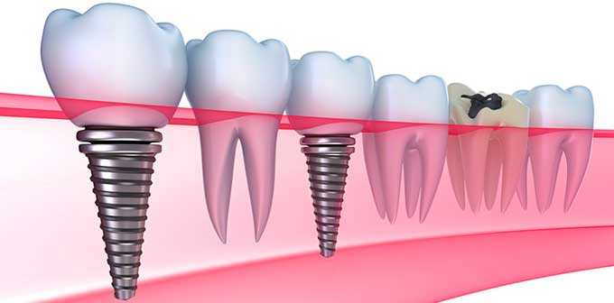 Импланты на зубы: за и против