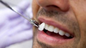 Кому нужны виниры в стоматологии?