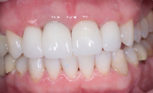 Коронки на передние зубы и плюсы