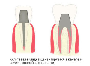 Вкладки культевые в стоматологии