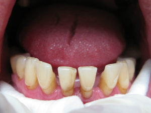 Протезирование зубов при парадонтозе. Что выбрать?