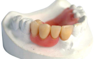 Акриловые зубные протезы Сумы
