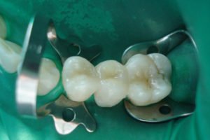 Вантовое протезирование зубов