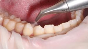 Чистка зубов ультразвуком в стоматологии