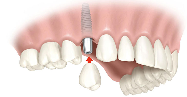 Преимущества имплантов перед протезированием
