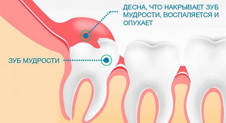 Что делать, когда зуб мудрости болит?